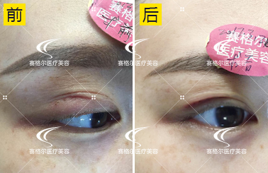 失败双眼皮修复手术【赛格尔马强每日整形案例 3.29】