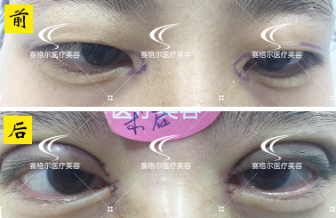 重庆赛格尔医美眼综合整形：重睑术+开眼角手术
