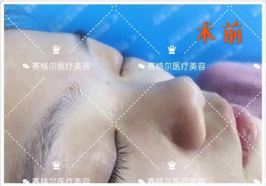 马鼻子整形真人案例：隆鼻+鼻翼缩小+双眼皮手术前后对比