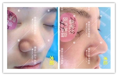 赛格尔鼻整形案例：假体隆鼻前后对比图片