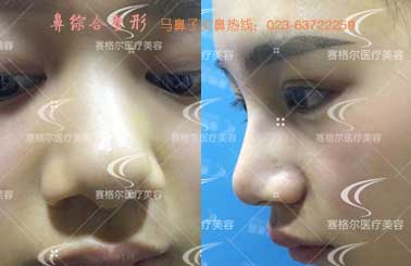 马鼻子鼻综合案例：假体隆鼻+鼻头整形+皮瓣鼻尖