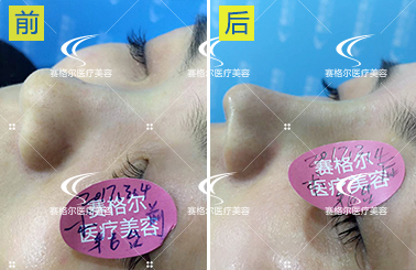 重庆马鼻子整形案例：韩式隆鼻手术前后对比照片