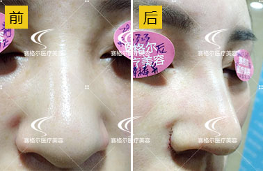 马鼻子鼻整形案例：棒棒鼻纠正+大鼻头缩小+鼻尖成形术