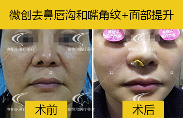 赛格尔整形案例：微创面部提升+祛鼻唇沟+去嘴角纹