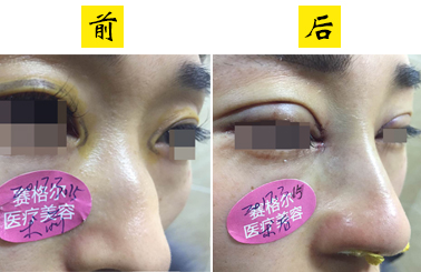 鼻眼综合整形：驼峰鼻矫正手术+眼综合整形